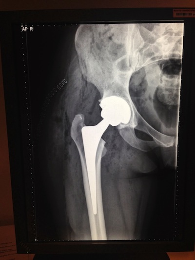 røntgen af hofte
